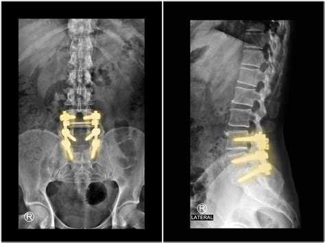 Laminectomy - Dr. Nael Shanti