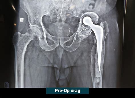 Revision Hip Replacement Surgery | Ahmedabad | Dr. Rachit Sheth