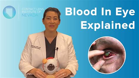 Subconjunctival Hemorrhage Blood In Eye Explained Causes | Hot Sex Picture