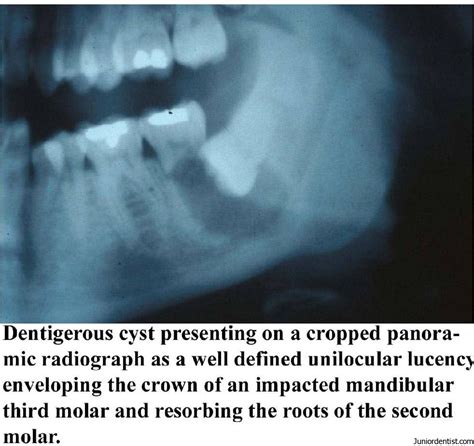 Dentigerous Cyst Definition, Clinical Features, Types, Radiographic ...