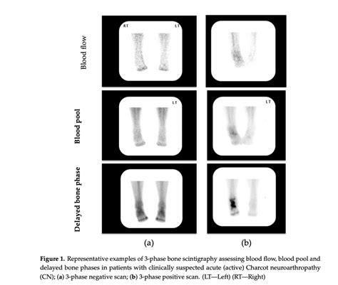 SPECT-CT in the early diagnosis of Charcot arthropathy - DF Blog