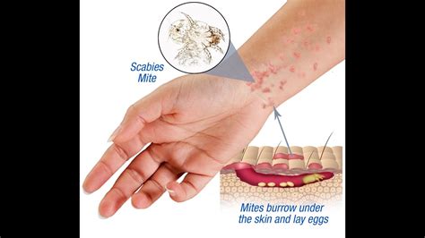 Scabies Types Causes Symptoms Treatment Ushc | The Best Porn Website