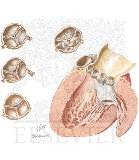 Degenerative Calcific Aortic Valve Stenosis May Originate From Slow ...