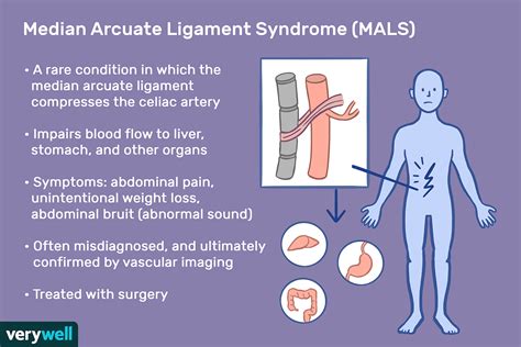 MALS (Median Arcuate Ligament Syndrome)