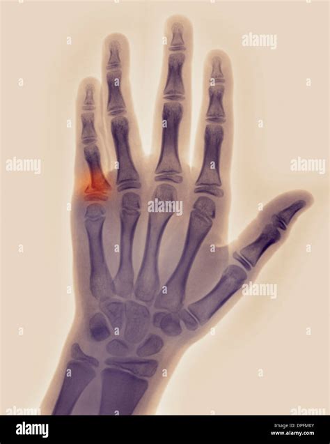 4th Proximal Phalanx Fracture