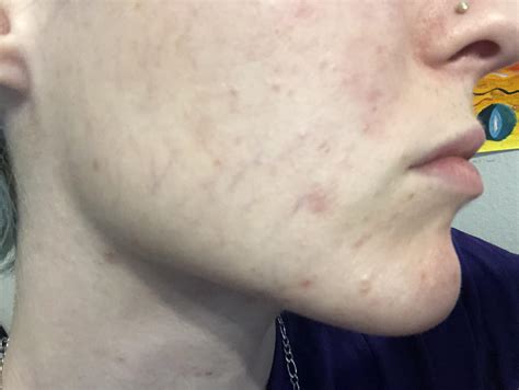 hormonal acne after getting off the pill. any advice?? : r/acne