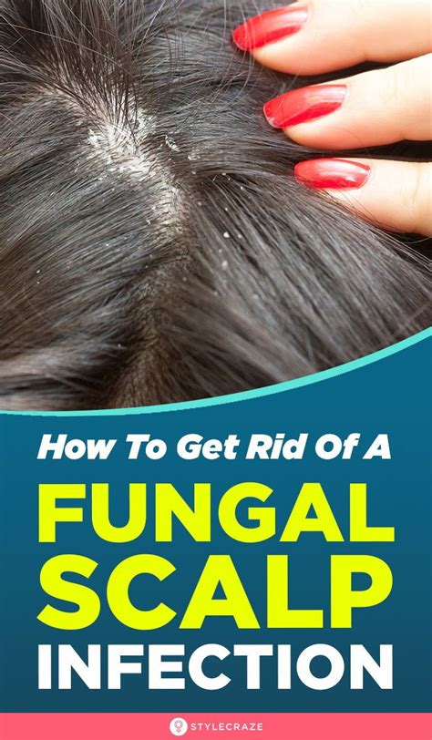 How To Get Rid Of Fungal Scalp Infection: 8 Natural Remedies | Dry ...