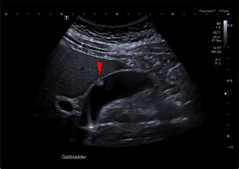 Gallbladder Polyps Ultrasound