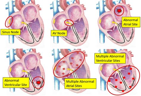 ACLS Rhythms Learn Terminology, Definitions, Pathophysiology