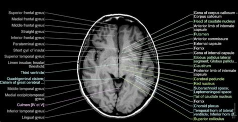 Cross-sectional Anatomy Of The Brain: Normal Anatomy, 60% OFF