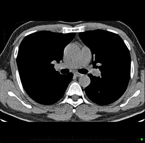 Chest CT Scan - Melbourne Radiology