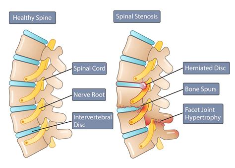 Spinal Stenosis Symptoms, Diagnosis & Treatment | Miami Neuroscience Center