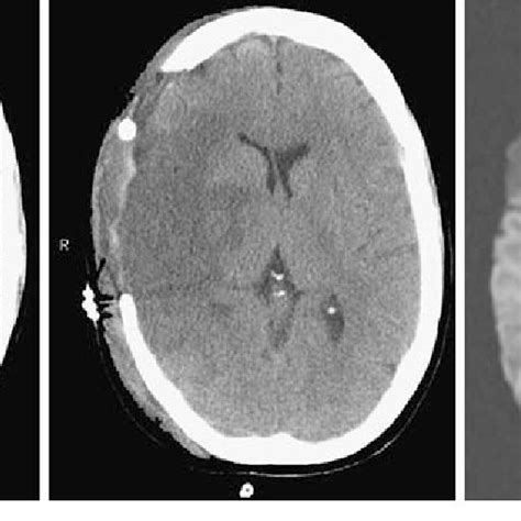 Malignant MCA syndrome. (a) CT brain scan showing signs of early right ...