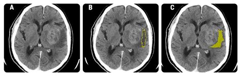 Brain Sciences | Free Full-Text | CT in the Differentiation of Gliomas ...