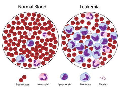 Acute Myeloid Leukemia - MBBCH Health Encyclopedia