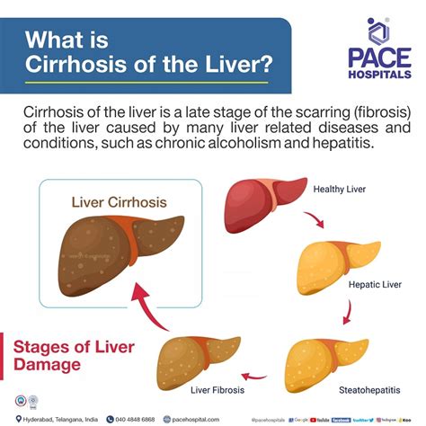 Liver Cirrhosis – Symptoms, Causes, Complications and Prevention