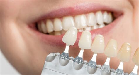 Porcelain Dental Veneers - Dentist on Harbourfront