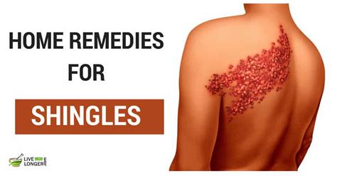 Home Remedies For Shingles