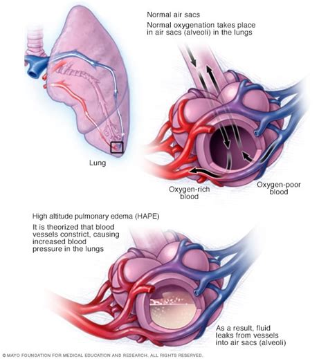 High-altitude pulmonary edema - Mayo Clinic