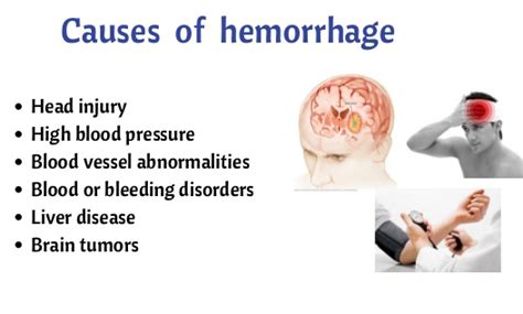 Brain hemorrhage symptoms and treatments - Life style and Fitness