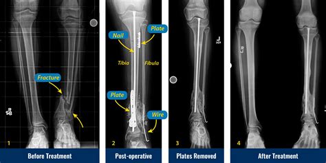 Tibia And Fibula Fracture Surgery