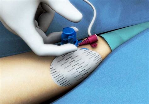 Radial Artery Catheterization|Medical Device Animation