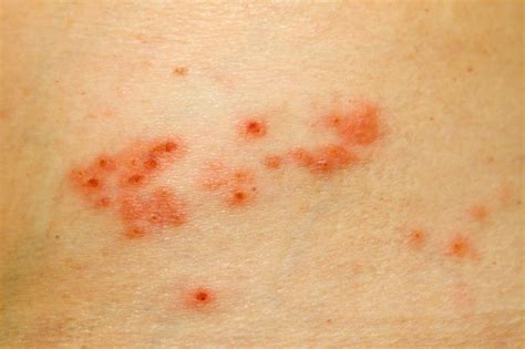 Remedies for Shingles Pain | ThriftyFun