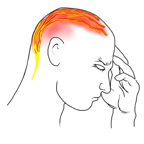 Cervicogenic Headache: Symptoms, Causes and Treatment