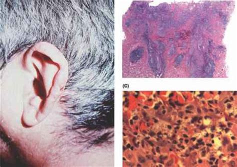 Other Intracytoplasmic Organisms - Dermatopathology