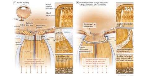 How Does Optic Nerve (Ganglion Cell) Damage Occur? | Glaucoma Australia