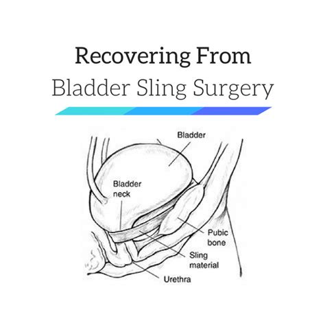 Bladder Sling Surgery Recovery After TOT, TVT, Bone-Anchored Procedures