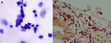 Cryptococcus Neoformans Gram Stain