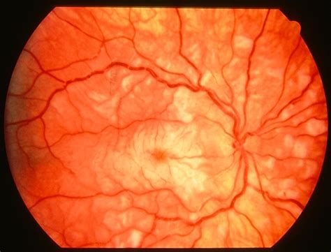 Purtscher retinopathy 2 right eye - Retina Image Bank