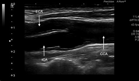 Figure 1 from Technical recommendations for the use of carotid duplex ...