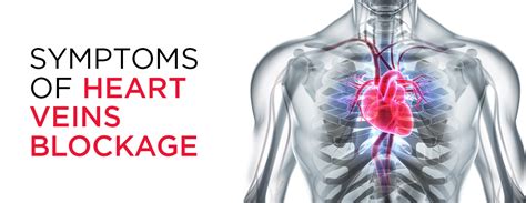 Symptoms of Heart Veins Blockage - MMI