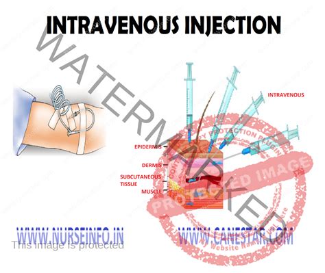 INTRAVENOUS INJECTION - Nurse Info