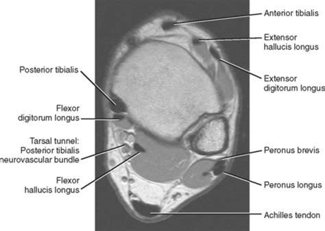 Foot Muscles Mri Anatomy / Get Mri Calf Anatomy Images - Roda Dunia ...