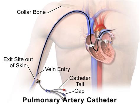 Pulmonary Artery Catheter | Encyclopedia MDPI