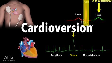 Cardioversion (Electrical) Procedure, Animation - YouTube