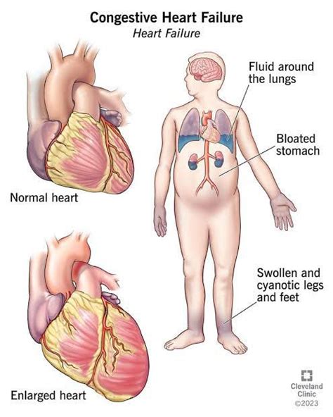 Congestive Heart Failure - MEDizzy