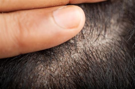 Eczema on Scalp: Causes, Symptoms & Effective Treatments