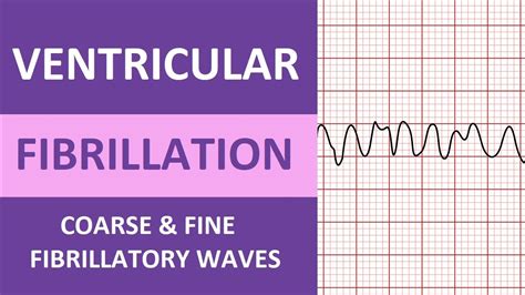 Coarse Ventricular Tachycardia