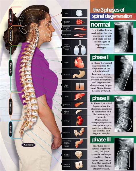 Stages of Spinal Degeneration | Continued education | Pinterest | Arthritis