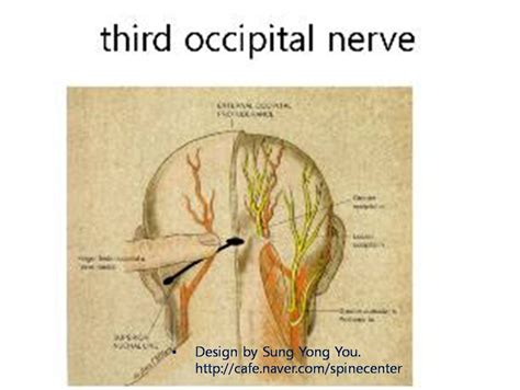 Third Occipital Nerve Headache - Headache