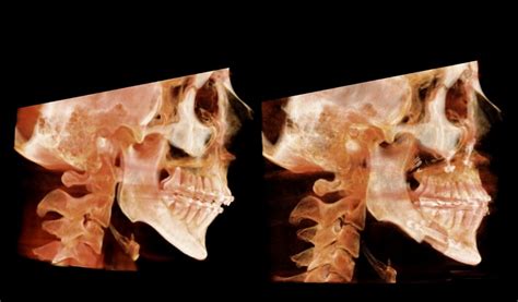 Maxillomandibular Advancement Surgery | Sleep Apnea Surgery Center