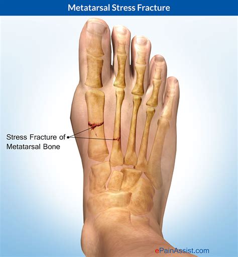 Metatarsal Stress Fracture: Treatment, Symptoms, Recovery, Causes