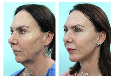 Double Chin Surgery - VIDA Wellness and Beauty