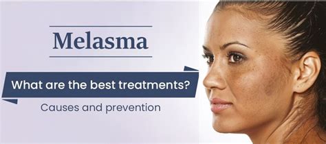 Melasma: What are the best treatment? Causes and prevention