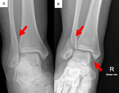 Ankle Fracture | Orthopaedic Trauma Association (OTA)