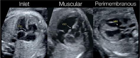 ventricular-septal-defect – SujyotHeartClinic